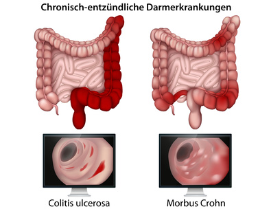 Chronisch - entzndliche Darmerkrankungen,betroffene Regionen Behandlung Wien
